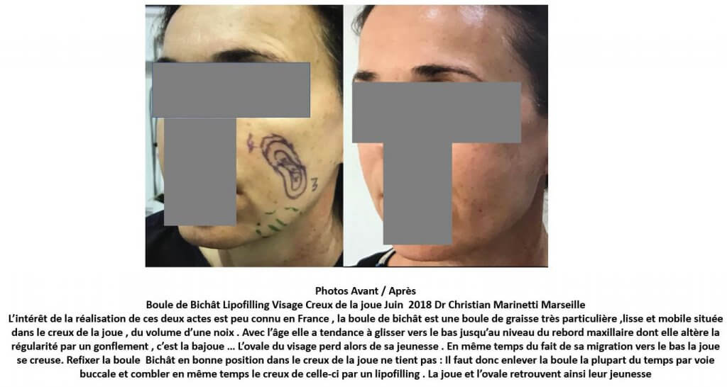 Bichectomie et Lipofilling du visage (juin 2018)
