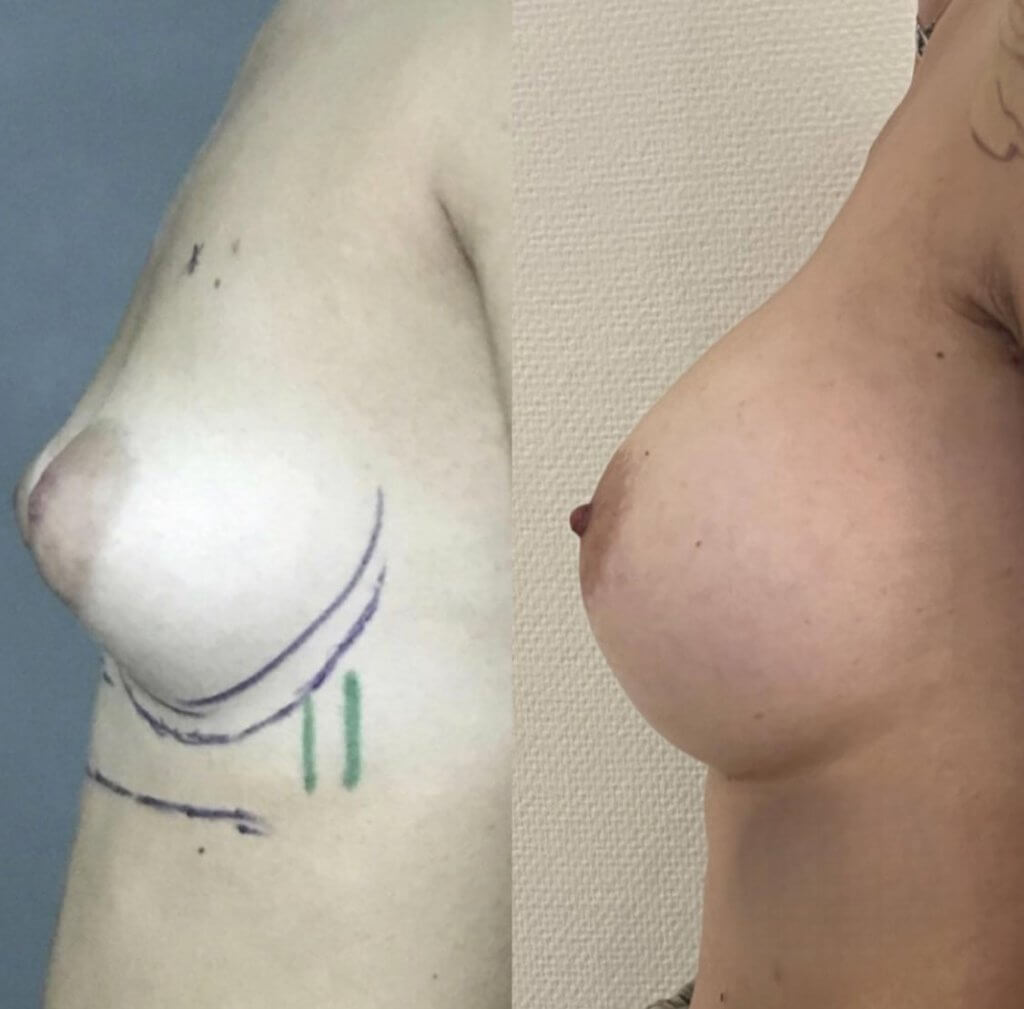 Augmentation mammaire implant 420cc