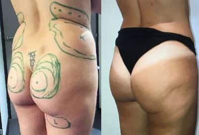 Lipoaspiration (octobre 2020)