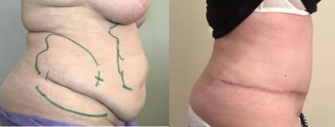Plastie abdominale (ventre, taille)
