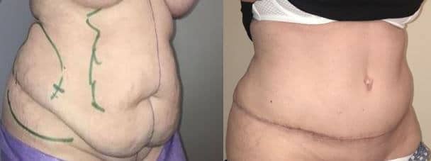 Plastie abdominale (ventre, taille)