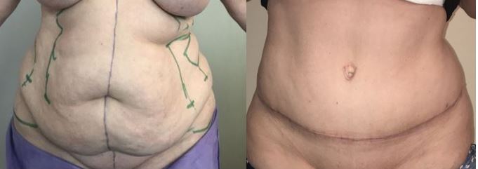 Plastie abdominale (ventre, taille)