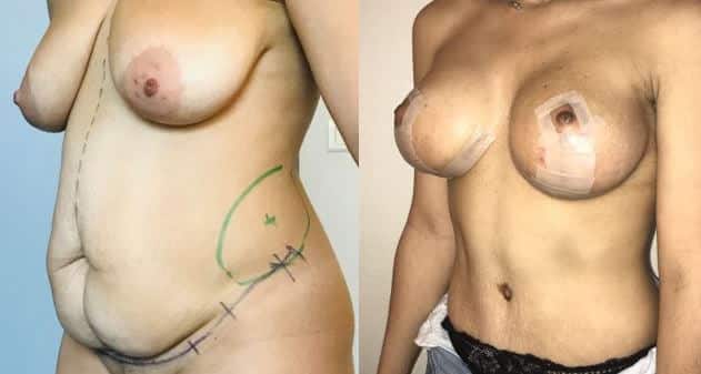 Plastie mammaire et plastie abdominale