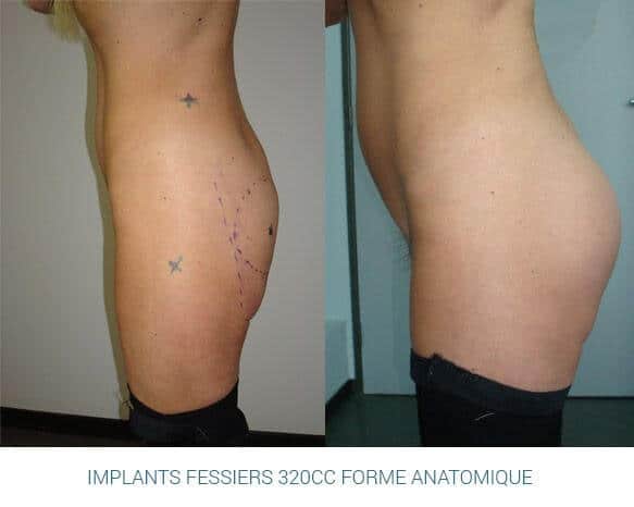Implants fessiers 320cc forme anatomique