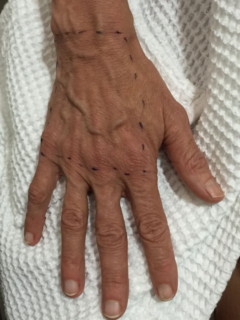 Lipostructure des mains - Chirurgie plastique