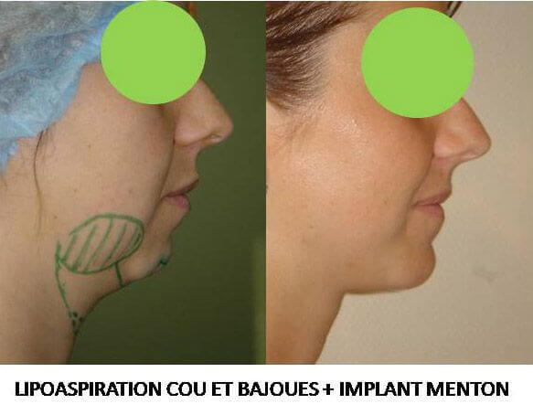 Lipoaspiration cou et bajoues et Implant menton (Génioplastie)