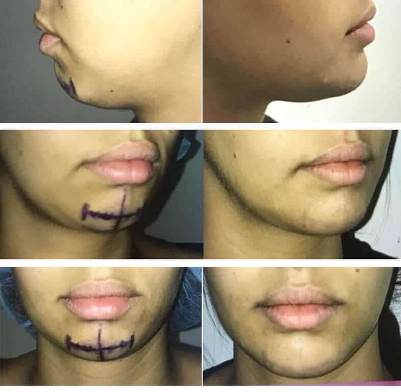Génioplastie - Chirurgie du menton