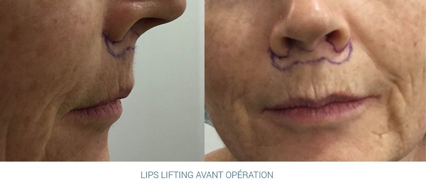 Lips lifting avant opération