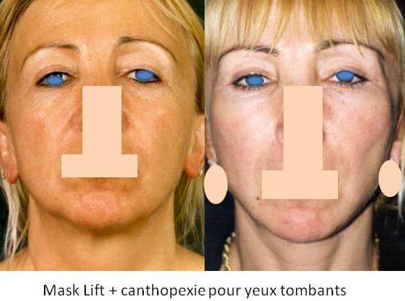 Mask lift et canthopexie pour yeux tombants