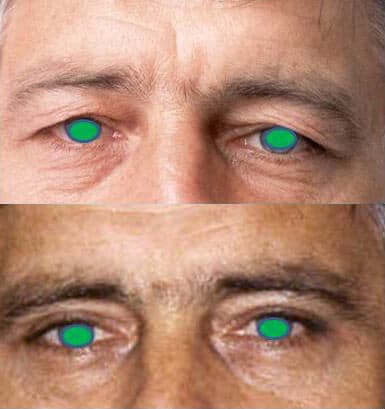 Blépharoplastie - Lifting des paupières - Rajeunissement