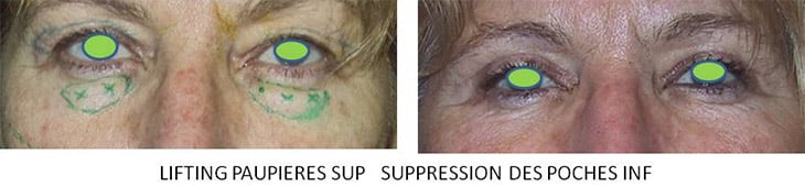 Blépharoplastie - Lifting des paupières supérieures et suppression des poches inférieures