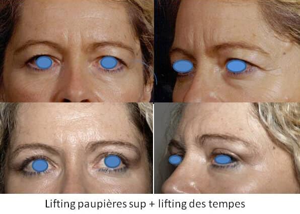 Lifting des paupières supérieures et lifting des tempes
