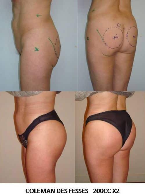 Coleman des fesses 200cc x2