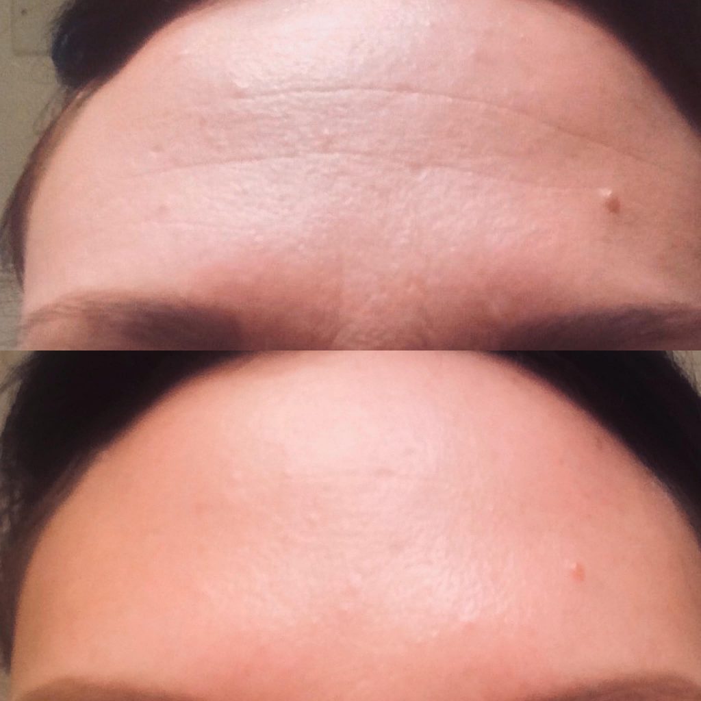 Injection Botox Homme