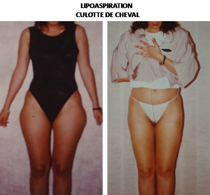 Lipoaspiration de la culotte de cheval