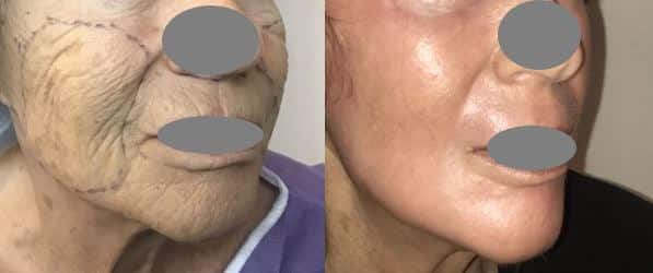 Peeling Profond Phenol