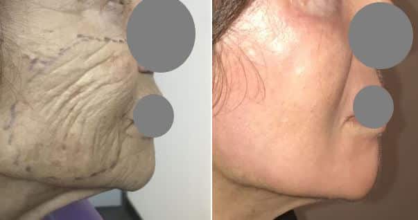 Peeling Profond Phenol