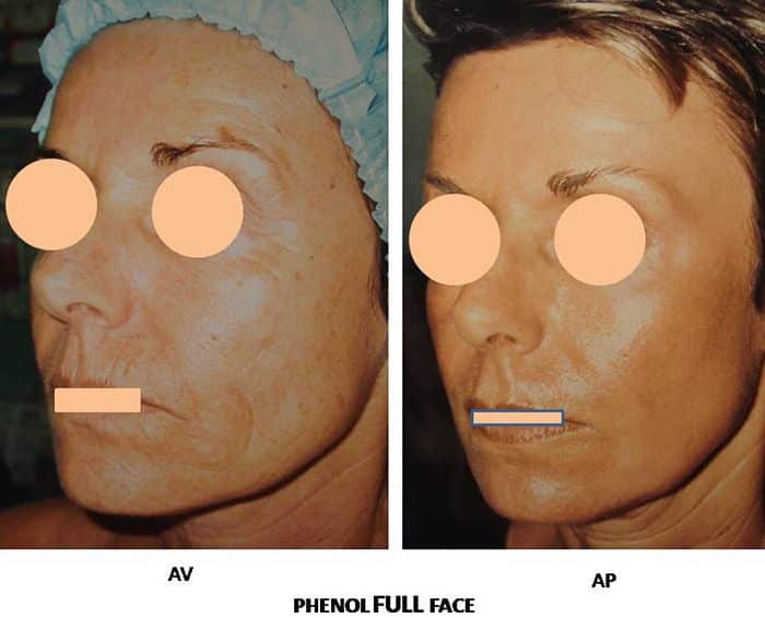 Peeling Phenol Full Face