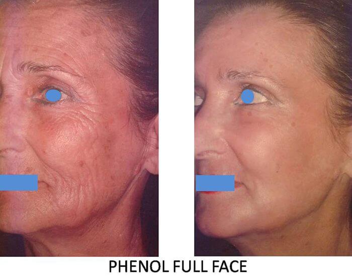 Peeling Phenol Full Face