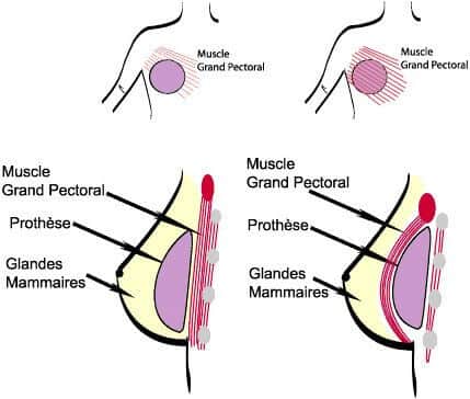 position implant mammaire devant ou derriere le muscle