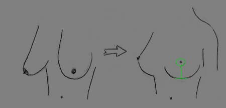 cicatrice plastie mammaire