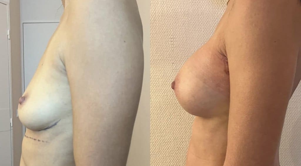 Implants mammaires 340cc rétro-musculaires sans cicatrice sur les seins (janvier 2025)