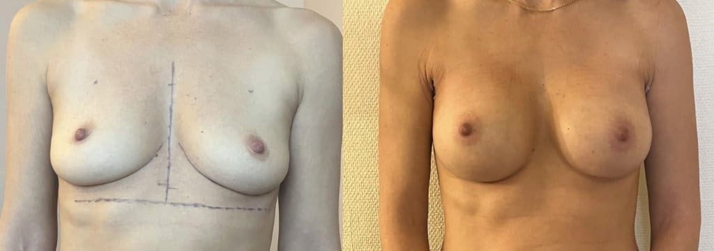 Implants mammaires 340cc rétro-musculaires sans cicatrice sur les seins (janvier 2025)