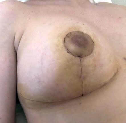Cicatrices plastie mammaire ( lifting des seins) à 2 mois post opératoires