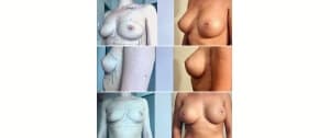 Implants mammaires 335cc