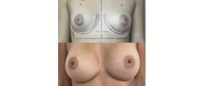 Implant mammaire 420cc
