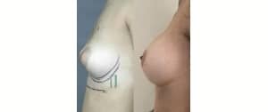 Implant mammaire 420cc