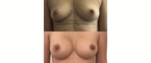 Implants mammaires (juillet 2023)