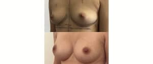 Implants mammaires (juillet 2023)