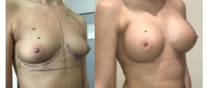 Implants mammaires anatomiques