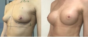 Implants mammaires anatomiques