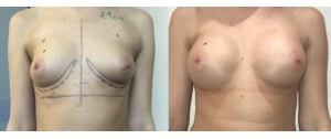 Implants mammaires anatomiques