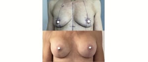 Implant mammaire et lifting des seins ptose