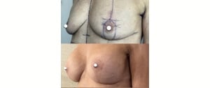 Implant mammaire et lifting des seins ptose