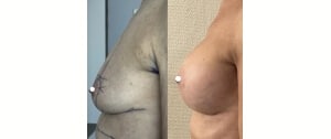 Implant mammaire et lifting des seins ptose