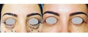 Chirurgie du visage, paupières