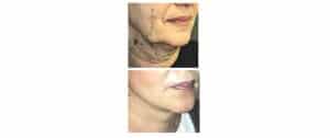 Face lift cervico-facial 