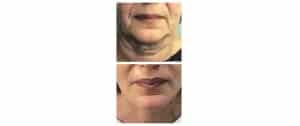 Face-lift cervico-facial