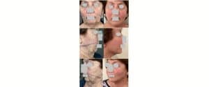 Face-lift musculaire exérèse boules bichât