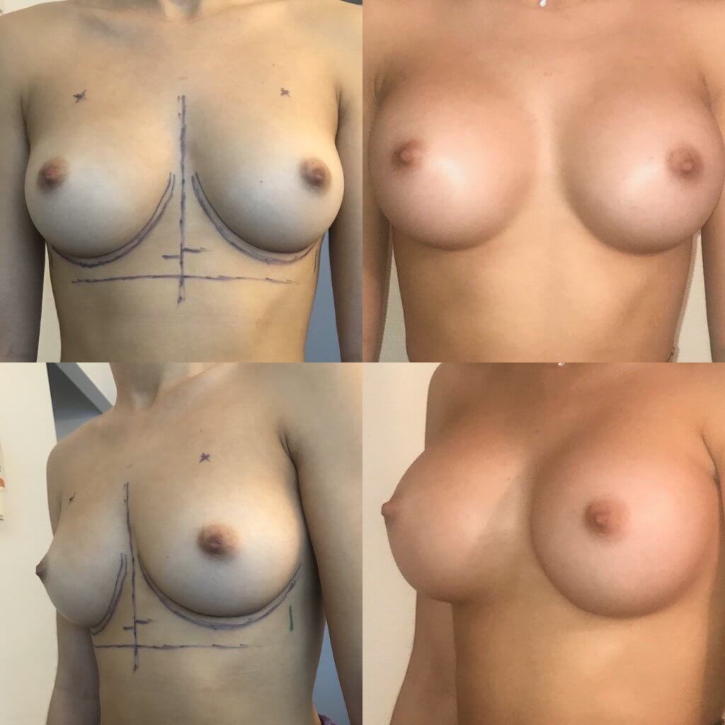 Implant pre musculaire