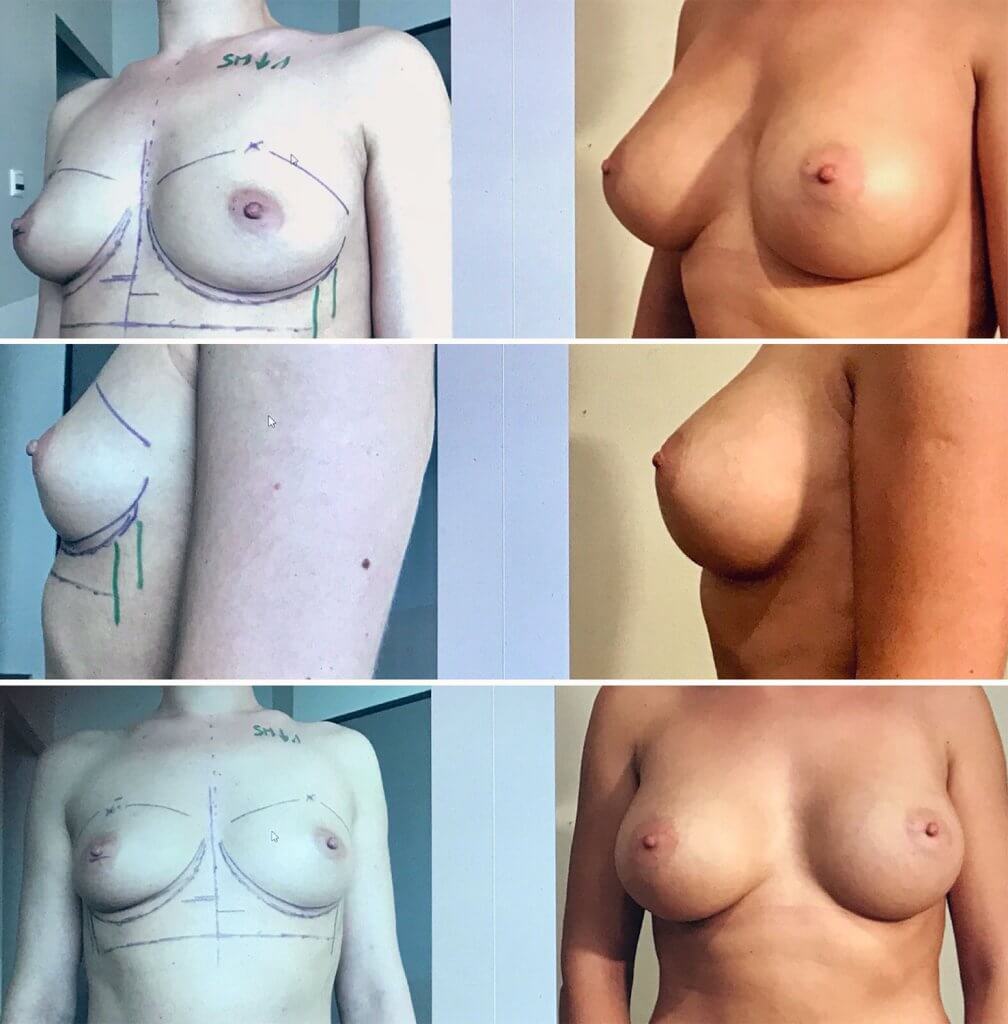 Implants mammaires 335cc