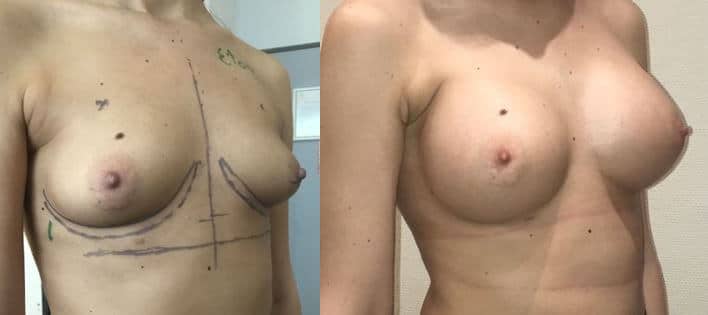 Implants mammaires anatomiques