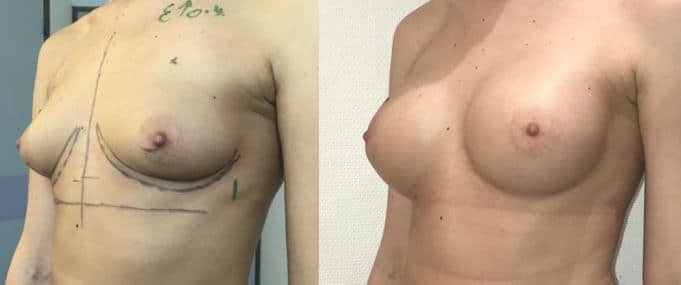 Implants mammaires anatomiques