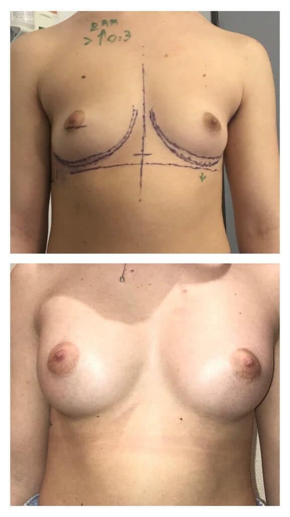 Implants mammaires anatomiques par voie axillaire (mars 2021)