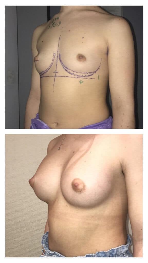 Implants mammaires anatomiques par voie axillaire (mars 2021)