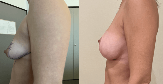 Implant mammaire et lifting des seins ptose
